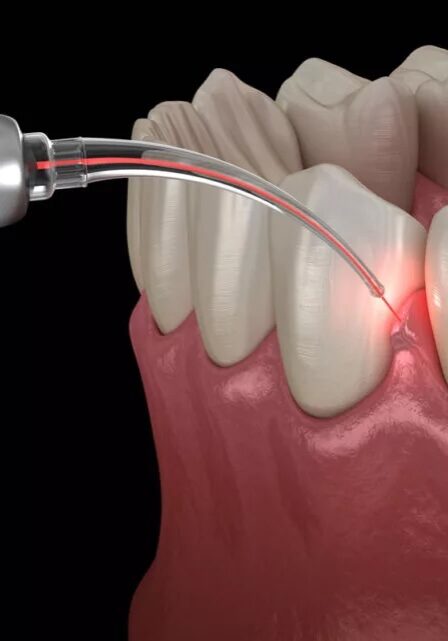 LANAP-Laser-Gum-Therapy-1024x641