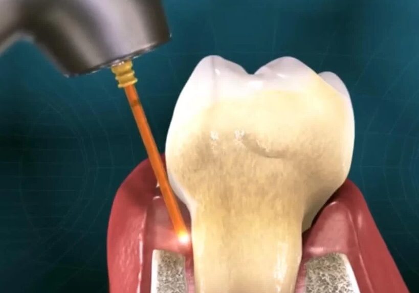 lanap periodontic laser treatment