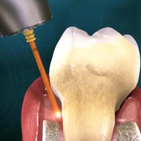 lanap periodontic laser treatment