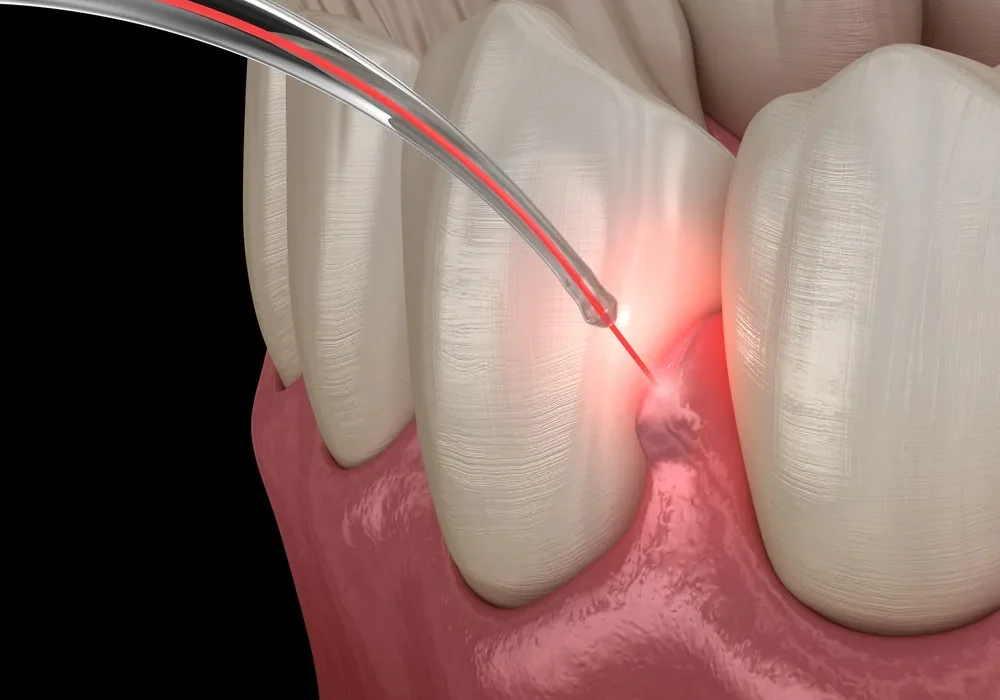 lanap west michigandental_laser4