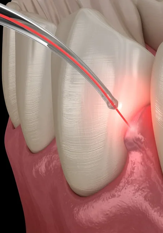 lanap west michigandental_laser4