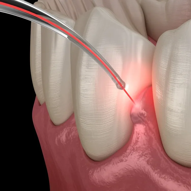 lanap west michigandental_laser4